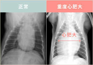 正常な心臓と、重度心肥大