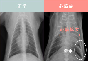 正常な心臓と、心筋症